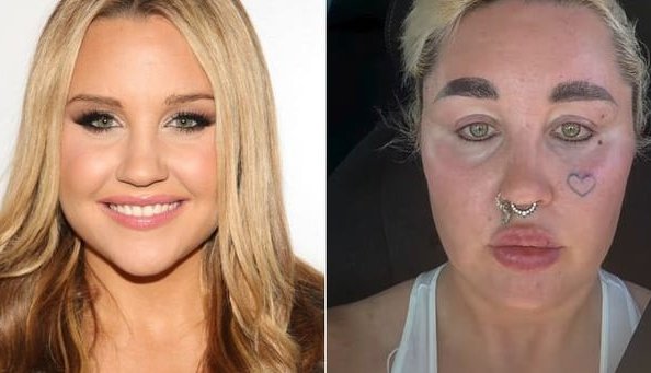 Amanda Bynes Stuns with New Lip Fillers and Weight Loss Glow at 39!
