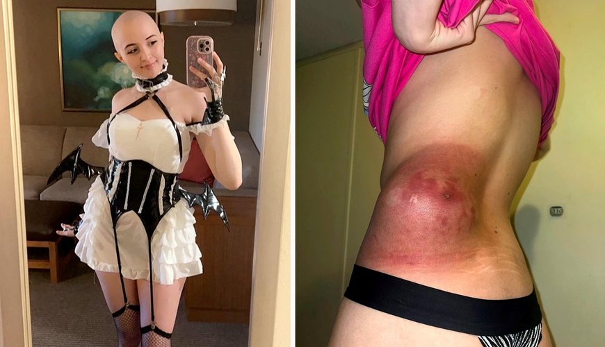 ‘Men love my bald head’: OnlyFans model diagnosed with rare cancer still makes £66,000 a year